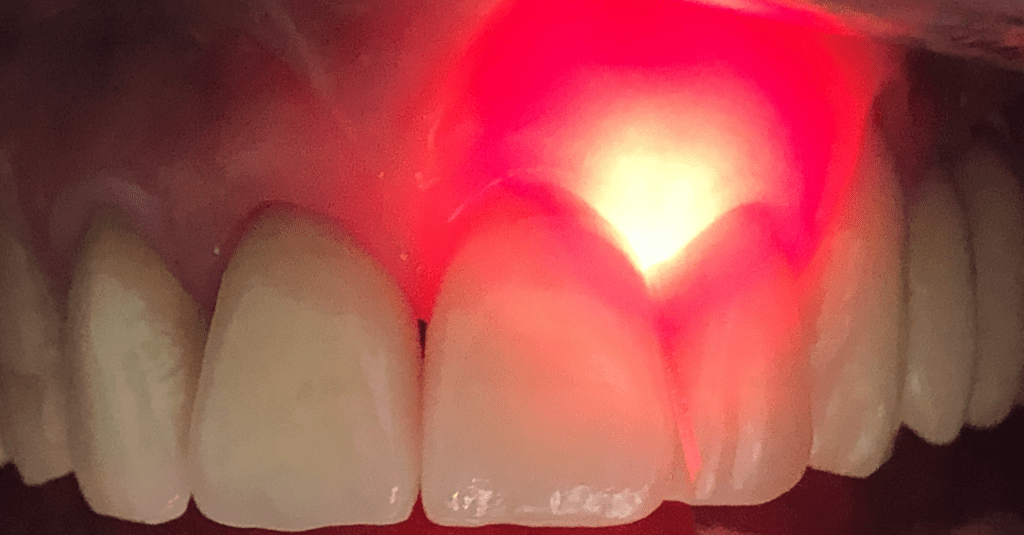 Lágylézer kezelés Smart Laser 2